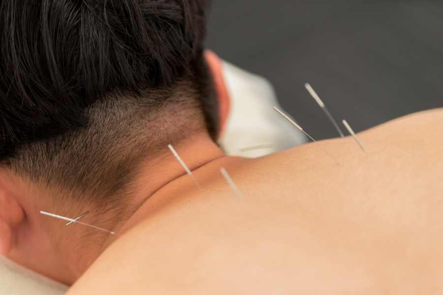 Fibromiàlgia i Acupuntura